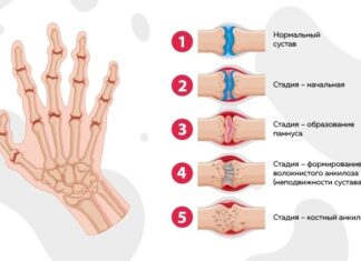 Артроз межфаланговых суставов